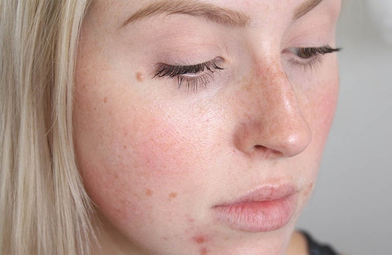 Dị ứng da mặt mẩn đỏ ngứa là gì và cách chữa hiệu quả cao