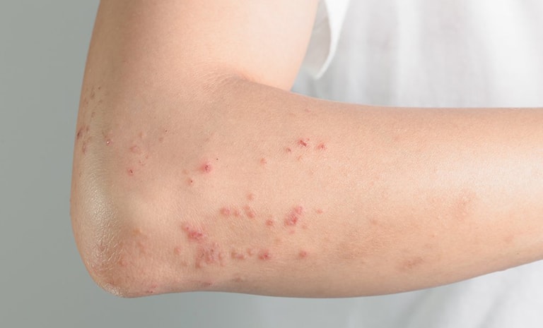 Dị ứng có nguy hiểm không? Phải làm gì khi bị dị ứng?