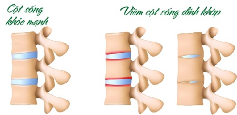 Viêm cột sống dính khớp thường dẫn đến gù cột sống và ảnh hưởng rất nhiều đến khớp háng gây khó khăn trong di chuyển.