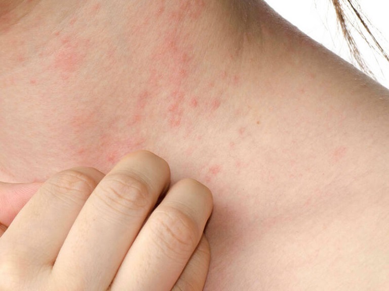 Triệu chứng nổi mẩn đỏ dưới da là hiện tượng dễ gặp và cảnh báo có thể bạn đang mắc một số bệnh da liễu