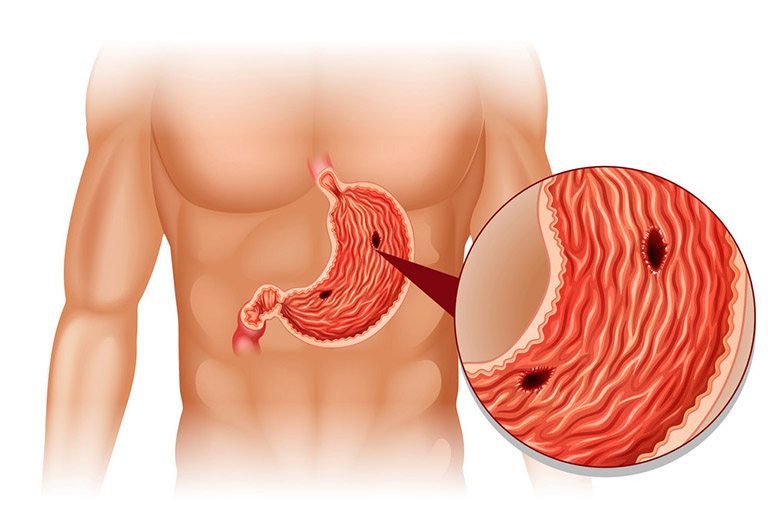 Viêm loét dạ dày nếu không được tiến hành điều trị kịp thời có thể gây ra nhiều biến chứng nguy hiểm làm ảnh hưởng xấu đến chức năng của dạ dày và sức khỏe của người mắc phải