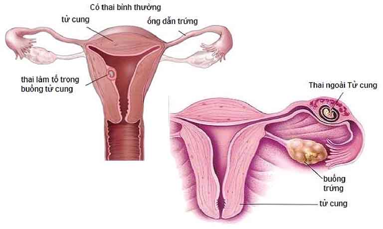 Nếu không được phát hiện sớm và điều trị kịp thời, bệnh có thể khiến phụ nữ mang thai ngoài tử cung 