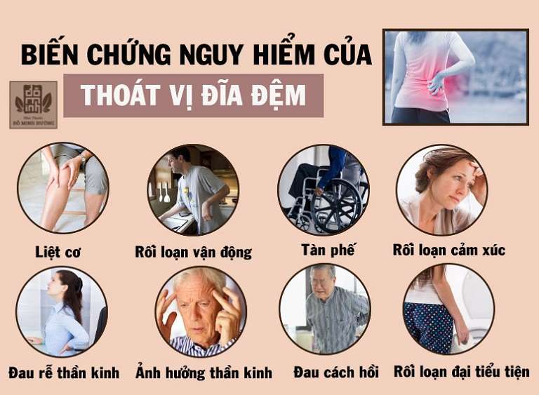 Chủ quan với thoát vị đĩa đệm có thể gây teo cơ, biến dạng khớp, thậm chí là bại liệt