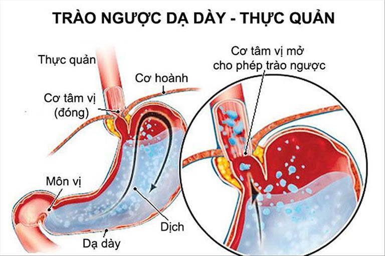 Trào ngược dạ dày thực quản