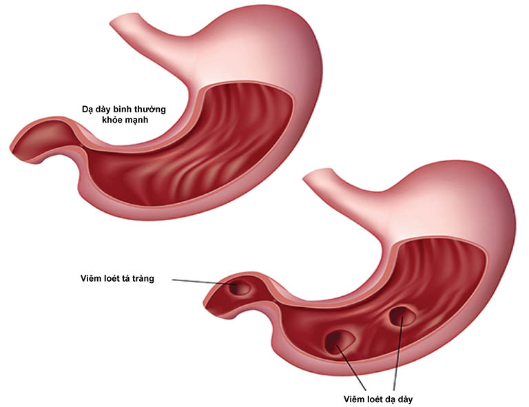 Viêm dạ dày tá tràng