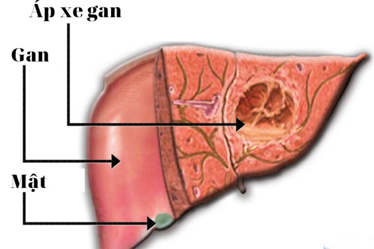 Áp xe gan