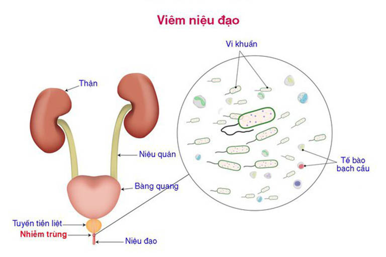 Bệnh viêm niệu đạo là tình trạng ống dẫn tiểu bị viêm, đoạn nối từ bàng quang ra khỏi cơ thể