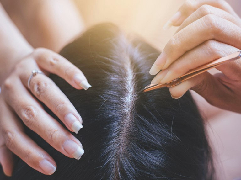 Tránh nhổ bỏ tóc bạc trong quá trình điều trị bởi việc này sẽ làm phá vỡ các nang chân tóc 