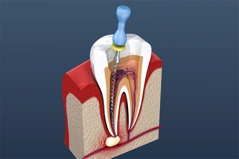 Lấy tủy răng là quá trình hút lấy phần tủy răng bị tổn thương hay bị hoại tử sau đó trám lại hoặc bọc răng sức mà không nhổ bỏ răng đau
