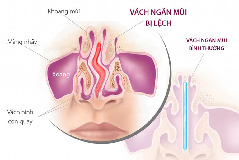 Lệch vách ngăn mũi là gì? Nguyên nhân và cách điều trị