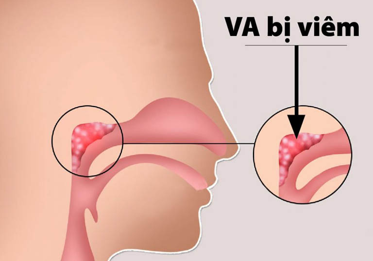 Đường hô hấp bị nhiều vi khuẩn xâm nhập khiến VA hoạt động quá tải và gây ra tình trạng viêm nhiễm VA