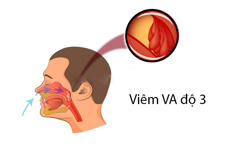 Viêm VA độ 3 là trường hợp nặng của bệnh viêm VA cấp tính gây ra nhiều triệu chứng bất lợi cho sức khỏe tổng thể nói chung và hệ hô hấp nói riêng