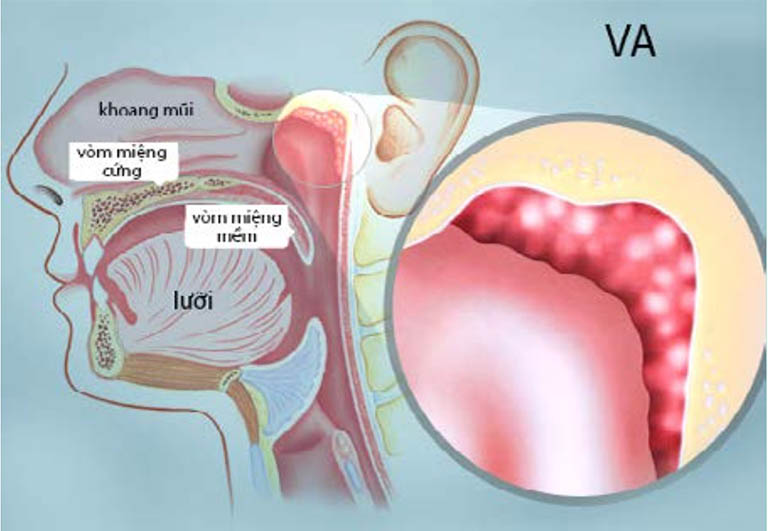 Viêm VA mãn tính xảy ra do sự tái diễn nhiều lần của bệnh viêm VA cấp tính