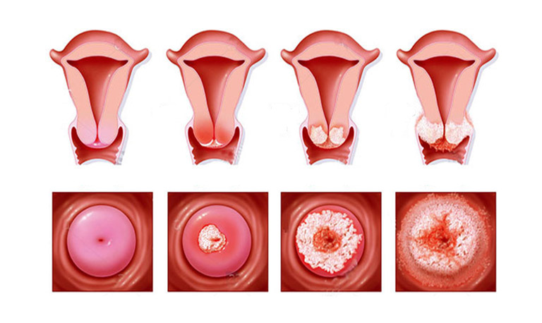 Tìm hiểu các giai đoạn của bệnh ung thư cổ tử cung và phác đồ điều trị tương ứng