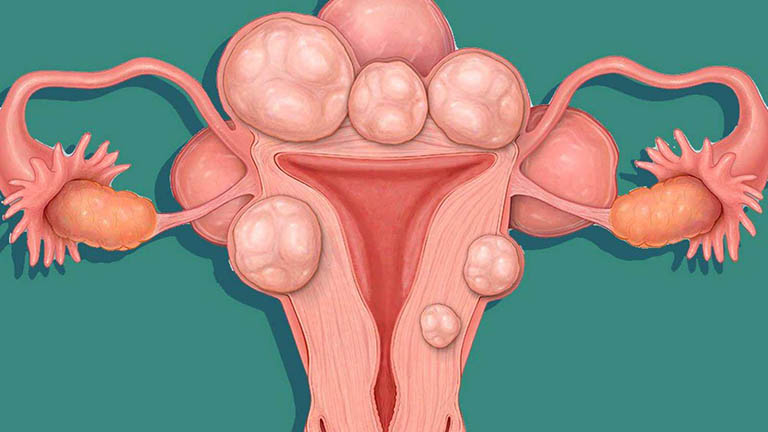 Các phương pháp điều trị u xơ tử cung không cần phẫu thuật
