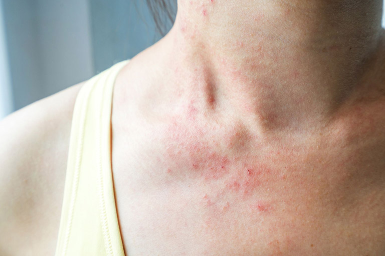 Trên da xuất hiện rải rác các nốt đỏ là một trong những dấu hiệu nhận biết bệnh sốt xuất huyết ở người lớn bên cạnh cơn sốt cao