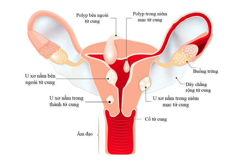 Vị trí của những khối u trong tử cung của người phụ nữ