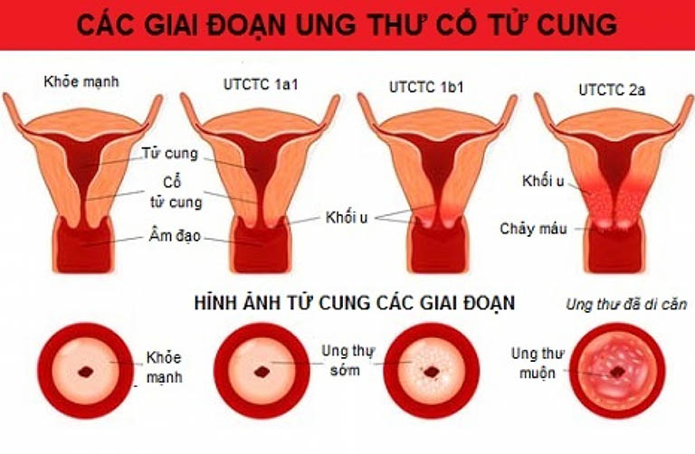 Những giai đoạn phát triển của bệnh ung thư cổ tử cung