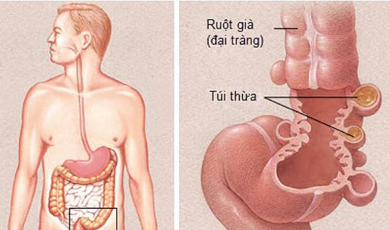 Bệnh viêm túi thừa đại tràng hình thành khi túi thừa đại tràng có dấu hiệu nhiễm khuẩn hoặc viêm