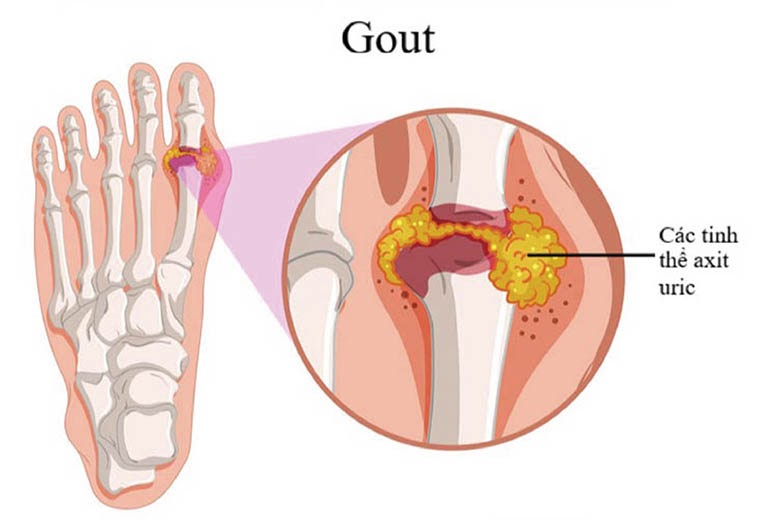 Bệnh gout khiến cơ thể không thể đào thải acid uric