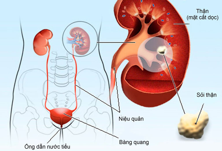 Ngày càng có nhiều người mắc bệnh sỏi thận