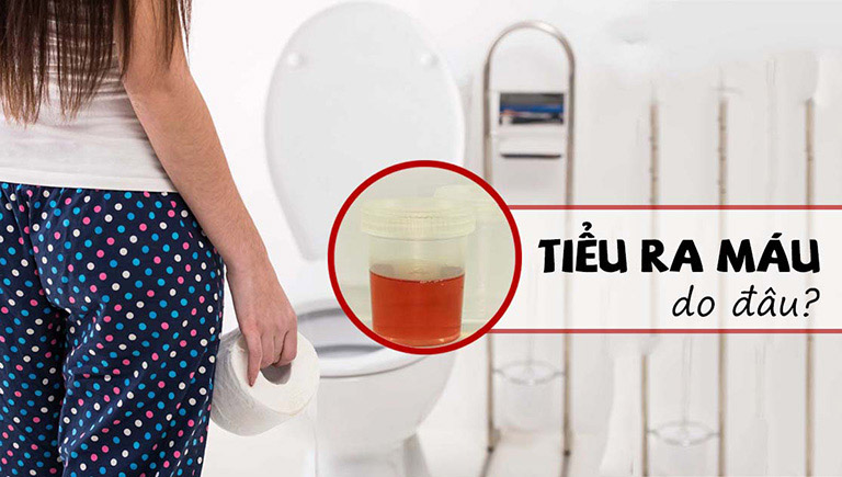 Tiểu ra máu là triệu chứng bệnh sỏi thận