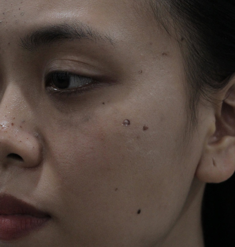 Dù điều trị rất nhiều nhưng tình trạng mụn trứng cá trên da của chị Trang vẫn không thuyên giảm