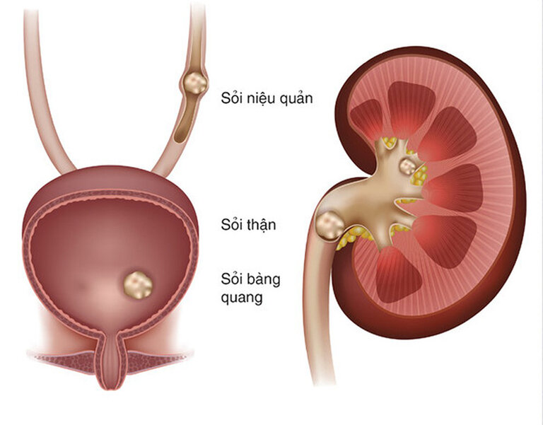 Sỏi niệu quản là tình trạng viên sỏi bị kẹt ở niệu quản gây tắc nghẽn ống dẫn nước tiểu