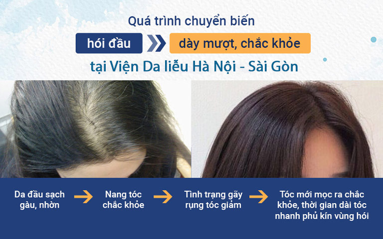 Quá trình chuyển biến của mái tóc sau khi sử dụng giải pháp kết hợp của Viện Da liễu Hà Nội - Sài Gòn