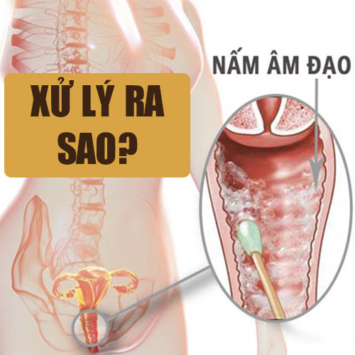 Kinh nghiệm “CẮT ĐUÔI” nấm â.m đ.ạ.o dai dẳng - Chỉ có nữ chuyên gia đầu ngành mới có thể tiết lộ cho bạn