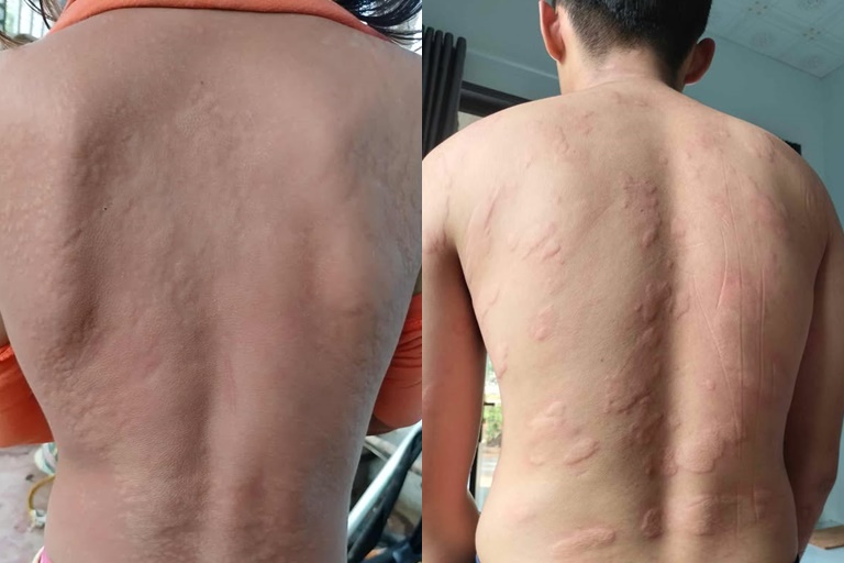 Mề đay toàn thân thể mảng