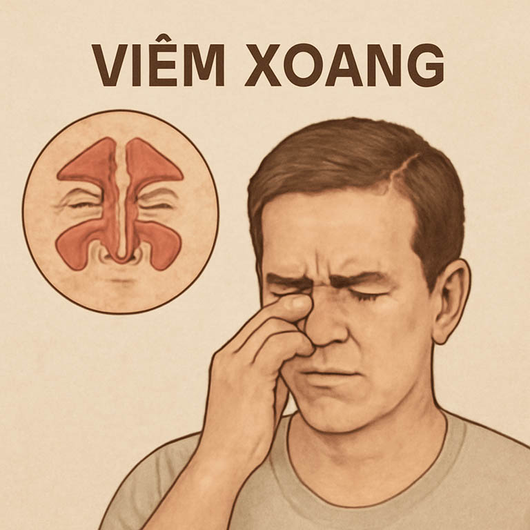 Số người bị viêm xoang ngày một nhiều Số người bị viêm xoang ngày một nhiều