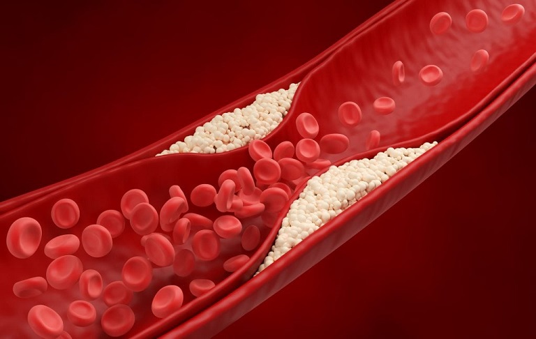 Khí huyết tắc nghẽm lâu ngày gây đau nhức xương khớp