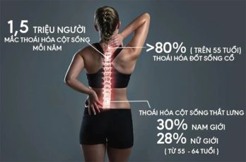 Tỷ lệ thoái hóa cột sống ngày càng gia tăng